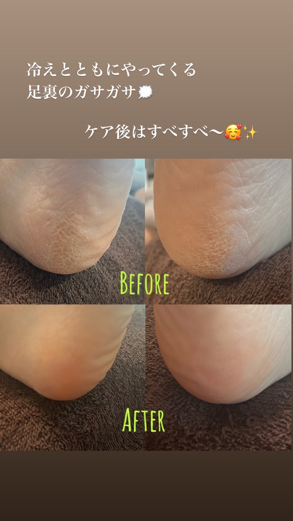 魚の目の原因、対処法について